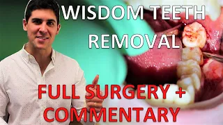 UPPER AND LOWER WISDOM TEETH REMOVAL (Partially Erupted Lower, Full Procedure, Sydney Australia) UPPER AND LOWER WISDOM TEETH REMOVAL (Partially Erupted Lower, Full Procedure, Sydney Australia)