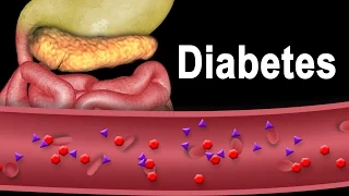 Diabetes Type 1 and Type 2, Animation. Diabetes Type 1 and Type 2, Animation.