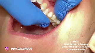 UL8 Wisdom tooth extraction by Specialist Oral Surgeon Dr. Abdul Dalghous