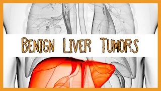 Benign Liver Tumors