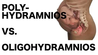 Polyhydramnios vs. Oligohydramnios