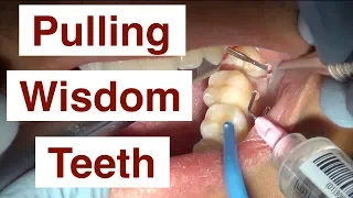 Pulling Wisdom Teeth Pulling Wisdom Teeth