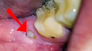Wisdom Tooth Pain: What you NEED to Know (Oral Sedation, Home Remedies and What to Expect) Wisdom Tooth Pain: What you NEED to Know (Oral Sedation, Home Remedies and What to Expect)
