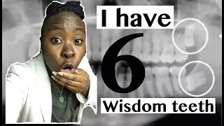 I HAVE 6 WISDOM TEETH || DENTAL APPOINTMENT #2